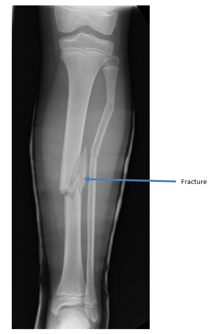 OrthoKids - Tibial Shaft Fractures